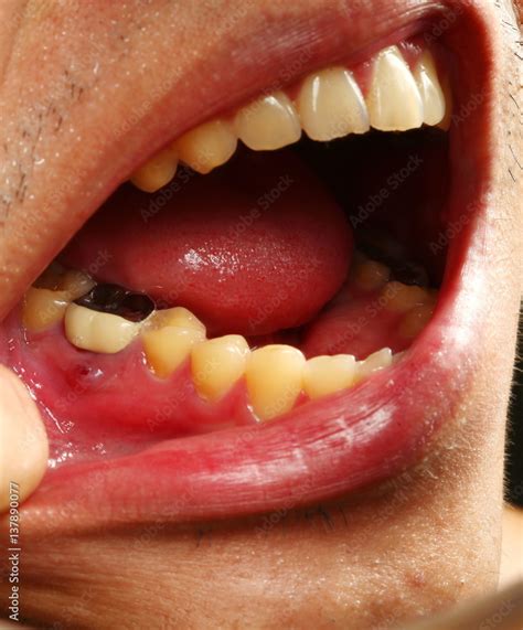 The Wound And Bleeding At Gum In Oral Cavity Scene Represent Oral Care