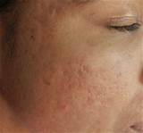 Laser Treatment For Acne Scars African American Pictures