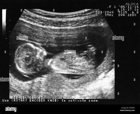 Ultrasound Of A 3 Month Old Fetus Stock Photo Royalty Free Image