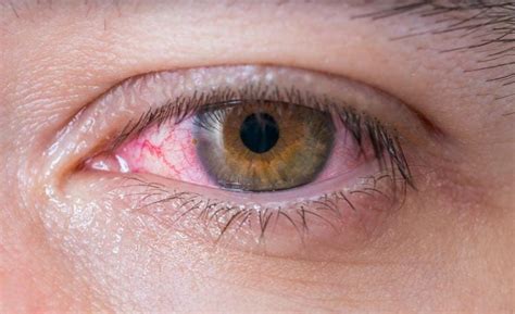What Are The Most Common Types Of Eye Infections That Exist Today