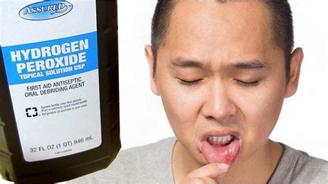 How To Get Rid Of White Swolleninflamed Taste Buds On Tongue