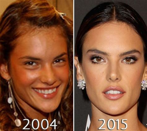 Alessandra Ambrosio Skin Before And After Photo Plastic Surgery Nose