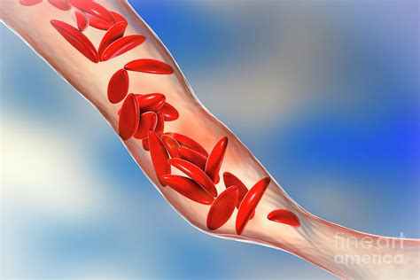 Blood Vessel Blocked In Sickle Cell Anaemia Photograph By Kateryna Kon Science Photo Library