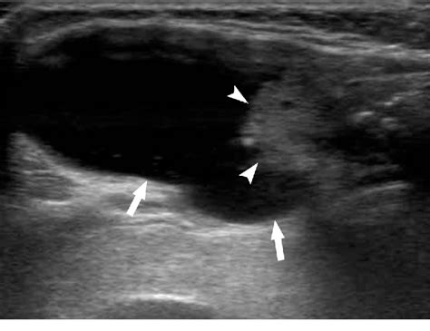 Figure 4 From Partially Cystic Thyroid Nodules Ultrasound Findings Of