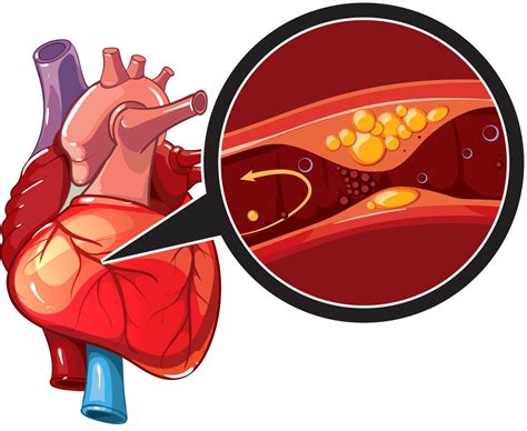 Coronary Artery Disease Treatment Causes Prevention