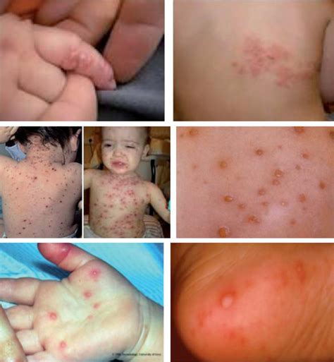Dermatitis Atopica Pdf Pediatria Free Software And Shareware