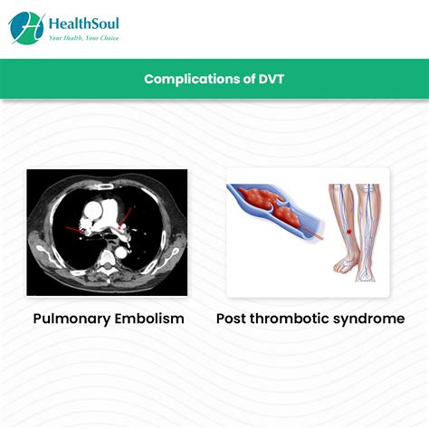 Learn The Early Signs Of Dvt And Its Treatment Options Healthsoul