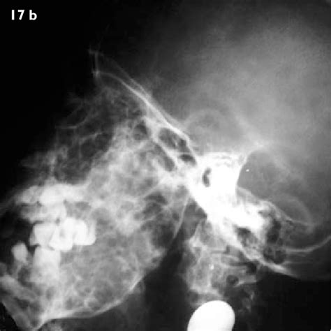 Cherubism A Posteroanterior And B Lateral Radiographs Show