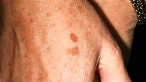 Liver Spots On Arms