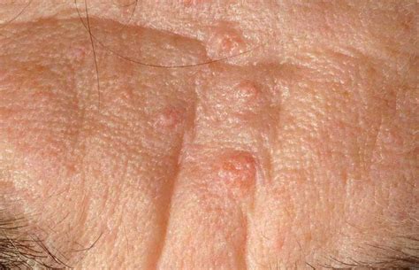 Sebaceous Hyperplasia Causes Symptoms And Removal