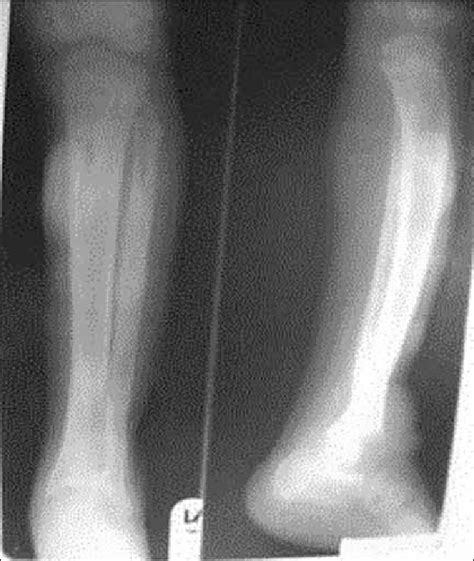Plain Radiograph Of The Right Tibia And Fibula Shows Anterior Bowing Of