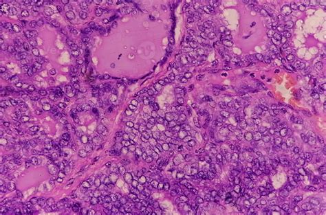 Thyroid Cancer Microscopic Image Of Metastatic Papillary Carcinoma Of
