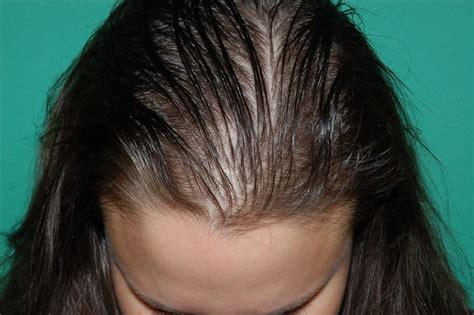 Hair Loss In Women Finding Out The Causes Of This Abnormality