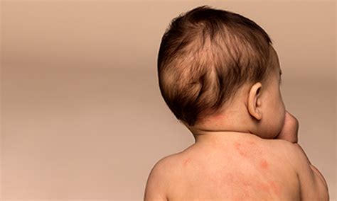 Baby Eczema On Skin Of Colour Aveeno®