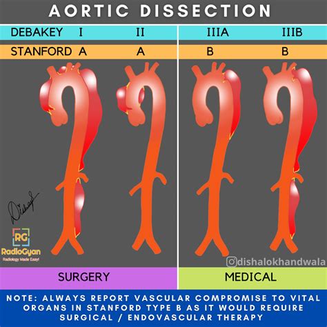 Aortic Dissection Radiology Reference Article Radiogyan