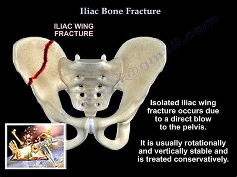 Iliac Bone Fracture Dr Nabil Ebraheim S Blog