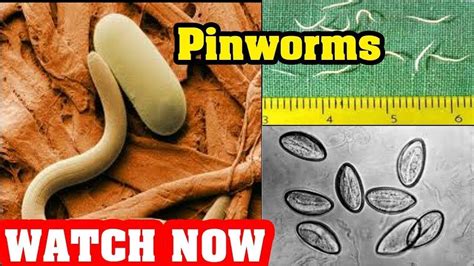 10 Ways To Get Rid Of Pinworms Fast And Naturally Youtube Medical