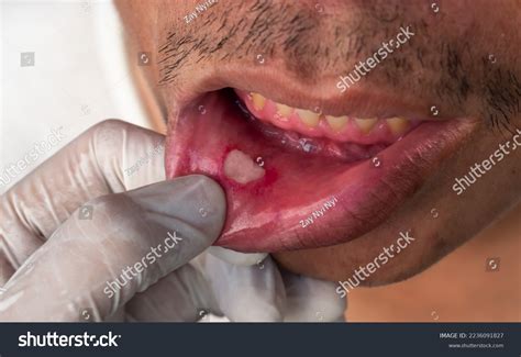 Aphthous Ulcer Canker Sore Stress Ulcer Foto Stok 2236091827 Shutterstock