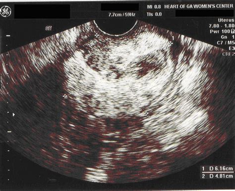 blog abnormal cervical smears abdominal ultrasound scans sexiz pix