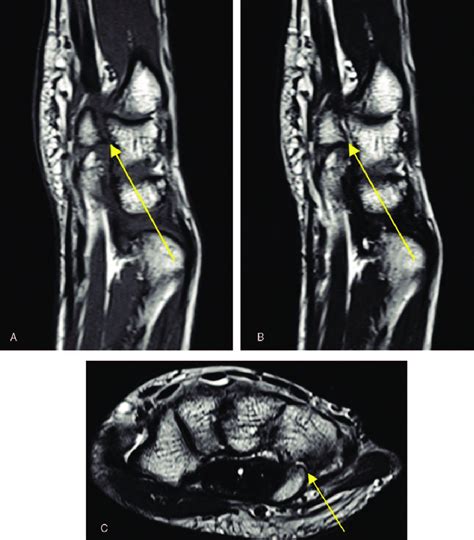 Wrist Mri Showing Hamate Hook Fracture In The Left Hand Without Download Scientific Diagram