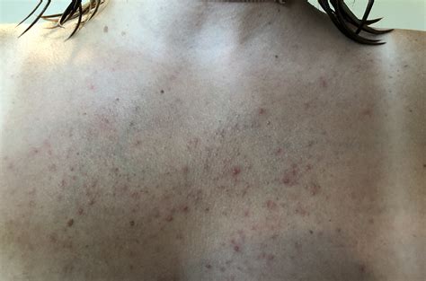 Small Bumps All Over Chest Backbodyneck Acne Forum