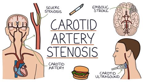 Understanding Carotid Artery Stenosis Youtube