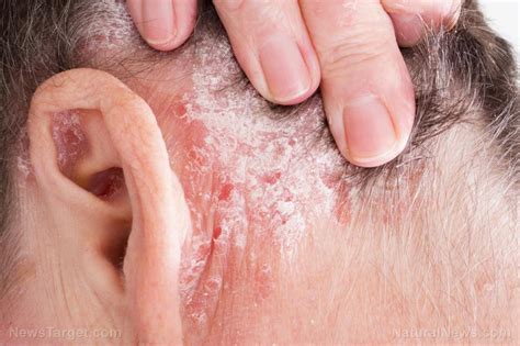 Acupuncture Found To Be An Effective Therapy For Psoriasis
