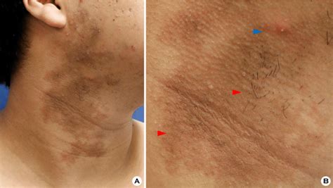A Well Demarcated Irregular Brownish Patches Unilaterally Seen On The