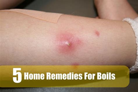 5 Best Home Remedies For Boils Health Care Pinterest