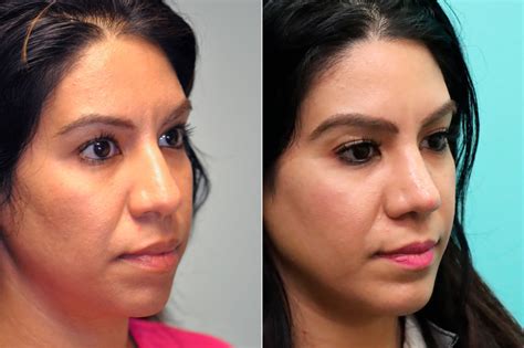 Chin And Facial Implant Rhinoplasty Photos Chevy Chase Md Patient 17613