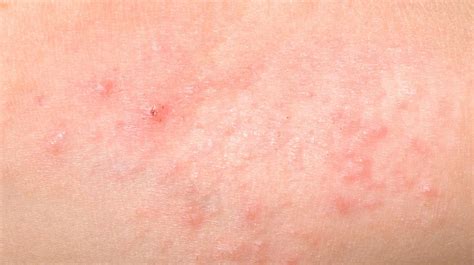 Heat Rash Vs Eczema How To Tell The Difference