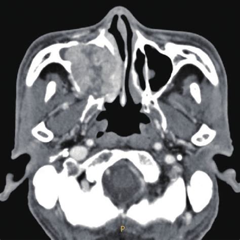 Paranasal Sinus Computed Tomography Scan Reveals 46 Cm Size Enhancing