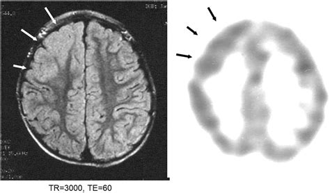 Epilepsy With Myoclonic Atonic Seizures Also Known As Doose Syndrome