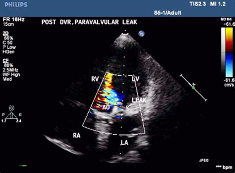 Device Closure Of Aortic Paravalvular Leak Asean Heart Journal