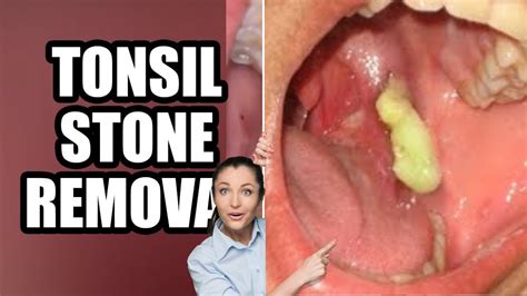 Tonsils Stone Removal Causes And Treatment 2021 Youtube