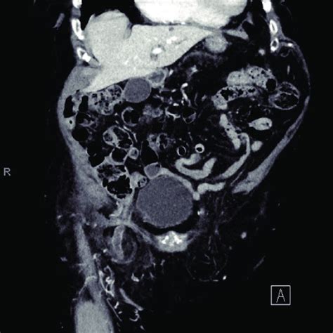 Ct Coronal Scan Right Femoral Hernia Containing Liquid Effusion And An