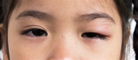 One Swollen Eyelids How To Reduce