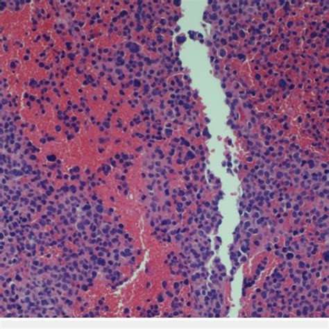 Pdf Bilateral Myelomatous Pleural Effusion In A Patient With Iga