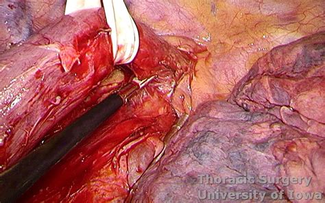 Esophagectomy with extended lymphadenectomy remains the mainstay of treatment for localized esophageal cancer. Esophagectomy: Three-field (McKeown) - Laparotomy and ...