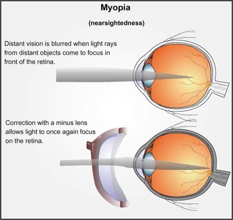 Myopia Short Sightedness Beckenham Optometrist