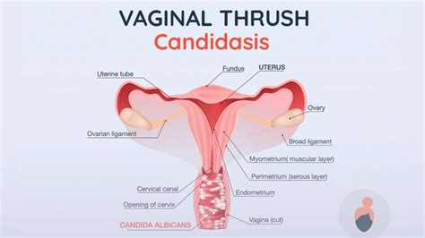 Vaginal Thrush Everything You Need To Know