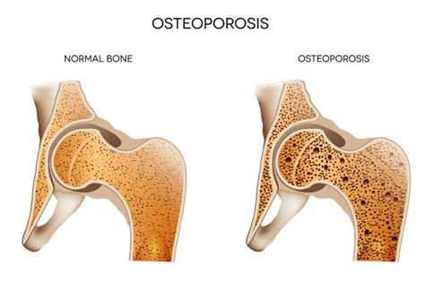 Prevent Certain Hip Fractures By Talking About Osteoporosis Love 2
