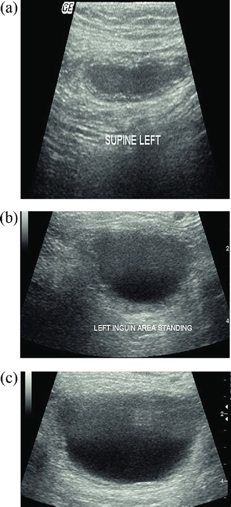 A B C Inguinal Hernia With Provocative Tests Download