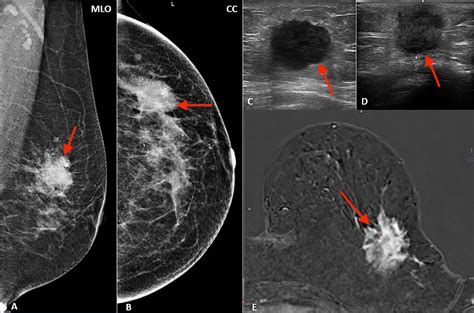 Frontiers Multimodality Imaging In Lobular Breast Cancer Differences In Mammography