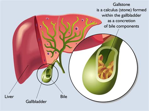 What Are Gallstones Or Gallbladder Stones