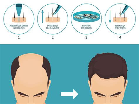 FUE Haartransplantation Methode Haarausfall Hilfe