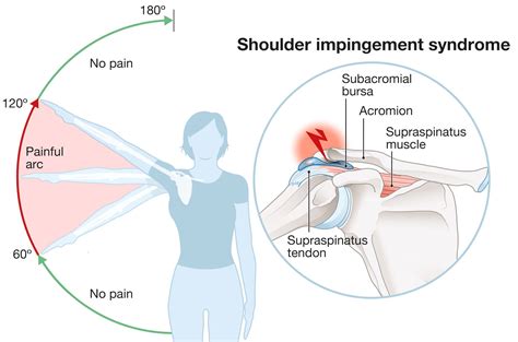 Shoulder Impingement Syndrome Symptoms Causes Treatment Rehab Hot Sex Picture