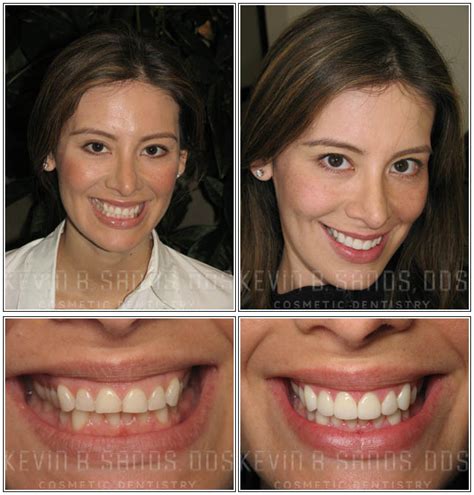 Porcelain Veneers Before And After