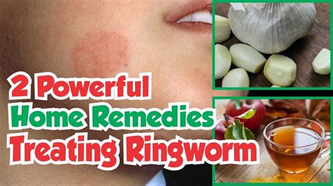 2 Powerful Home Remedies For Treating Ringworm Youtube