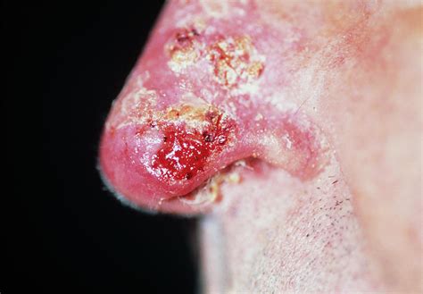 Skin Cancer On Nose Photograph By Dr P Marazziscience Photo Library